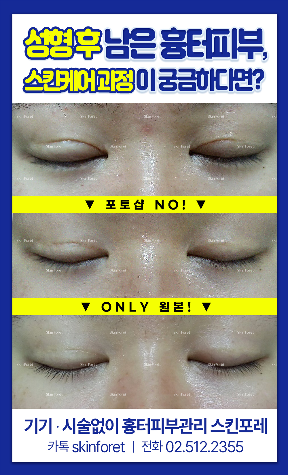 소세지눈과 마카롱눈 및 쌍꺼풀 흉터, skinforet 케어 사례
