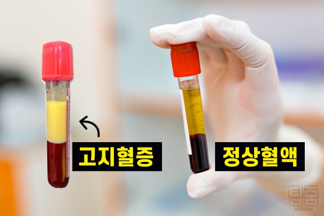 고지혈증 좋은 음식 고지혈증약 스타틴 효과