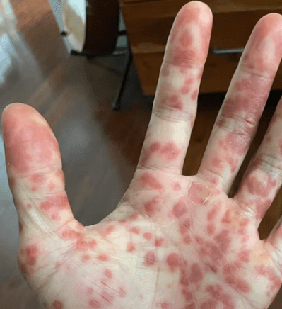 엠폭스 감염 증상으로 손바닥에 수포가 올라온 사진