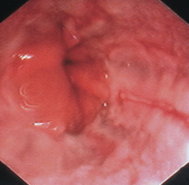 역류성식도염-내시경-모습