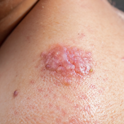 3. 대상포진의 치료방법 및 빨리 낫는 방법