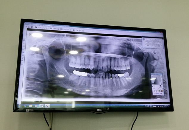 잇몸병이 치매까지? 치주염의 무서운 진실