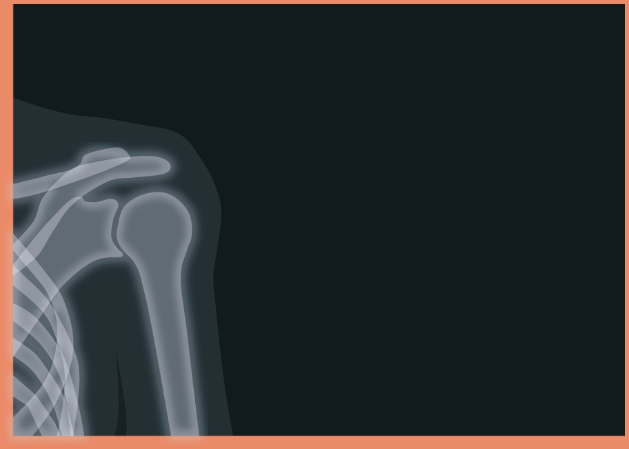 어깨충돌증후군이란? 발병 원인과 증상 총정리!