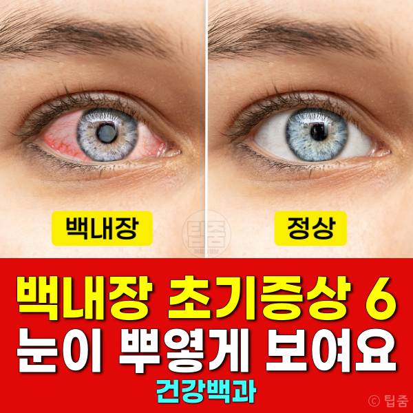 백내장 초기증상 눈이 뿌옇게 보여요 백내장 자가진단