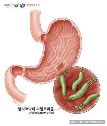 위암 원인부터 초기증상·치료·예방까지