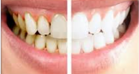 라미네이트 무엇 장점 단점