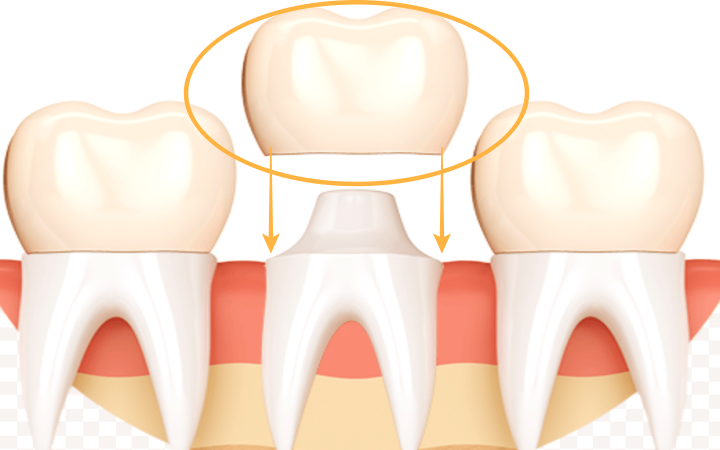 크라운을-치아에-씌우는-모습