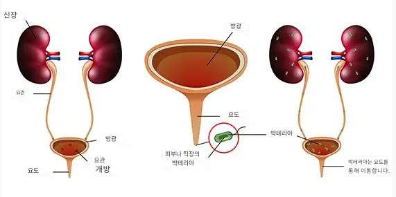 요로감염이란