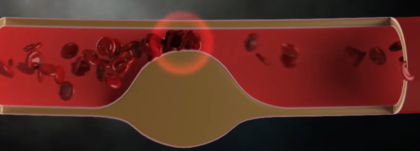 고혈압 이미지 혈관