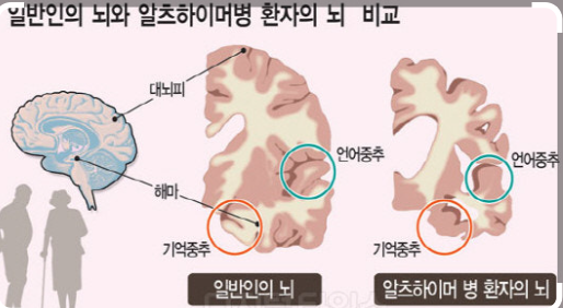 유방암 생존자와 알츠하이머병: 생존 후 뇌 건강 관련 이미지