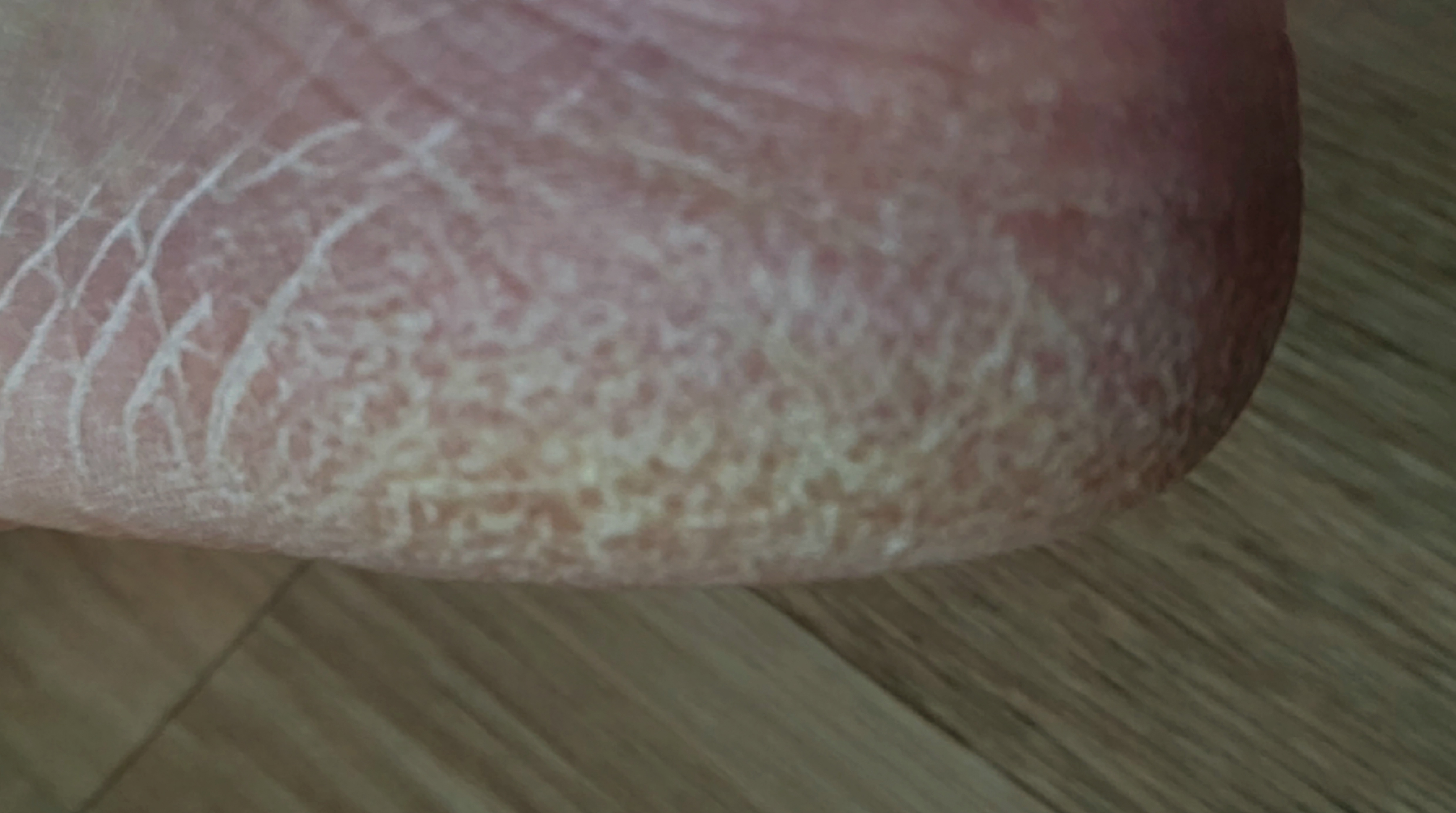 건조하고 갈라진 발뒤꿈치