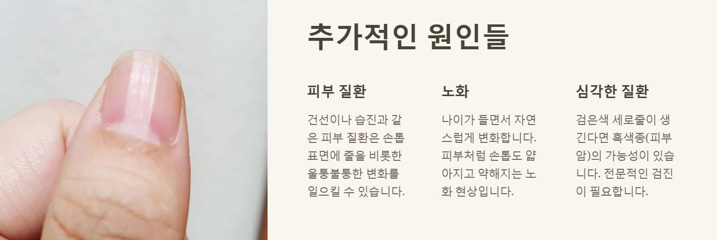 손톱에 세로줄이 생기는 이유