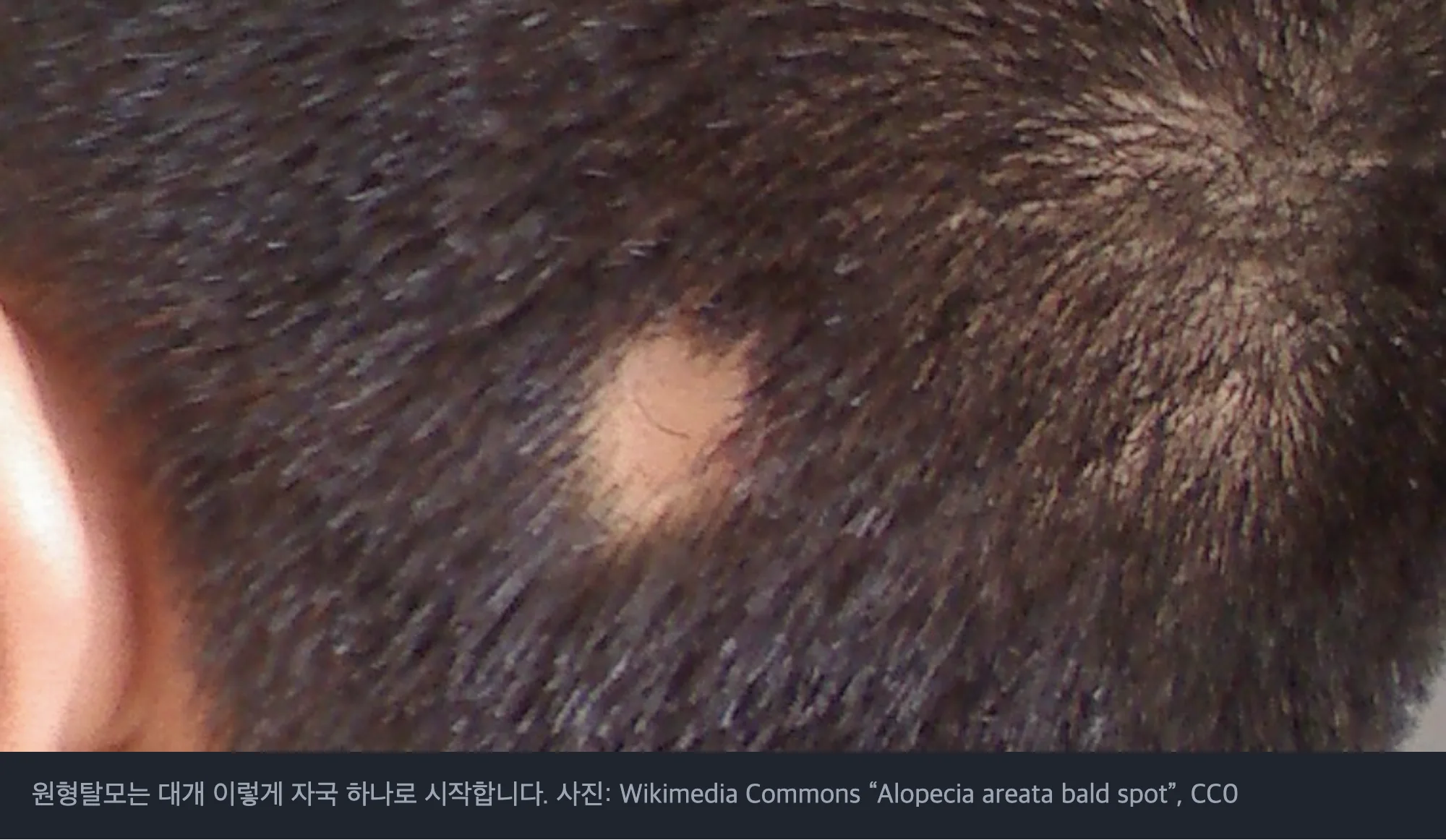 원형탈모 초기 증상. 뒤통수에 동전만 한 크기의 탈모 자국이 하나 생긴 실제 사진