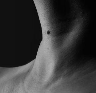 두드러기 치료방법 진단 기준 합병증