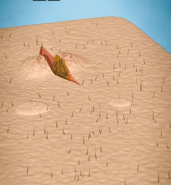 곤지름 초기증상