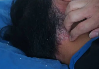 지루성 두피염 증상3