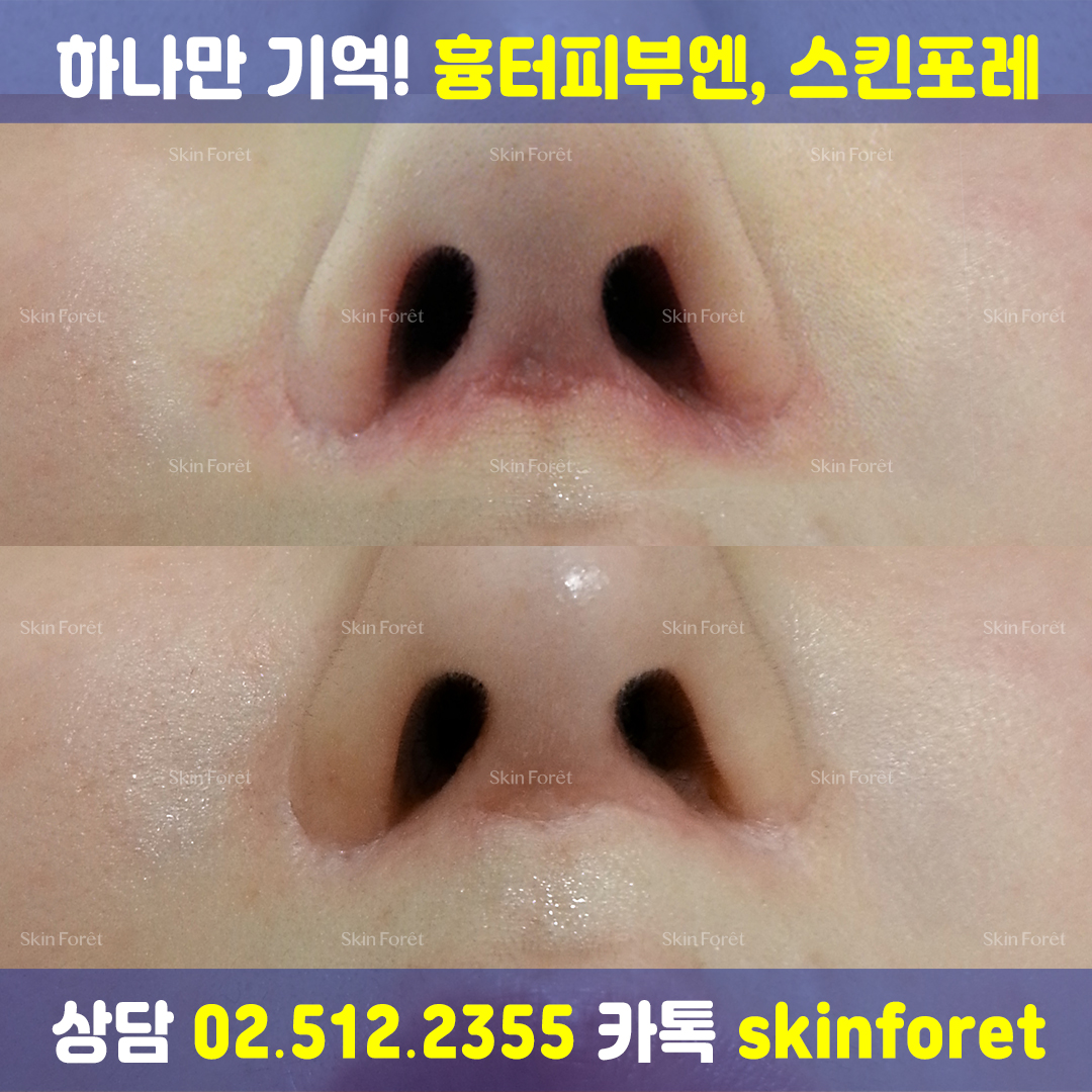 인중축소술과 코 성형 전후, 부작용 최소화 개선 사례