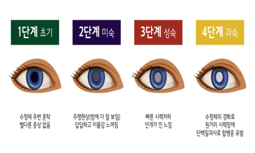 백내장 증상