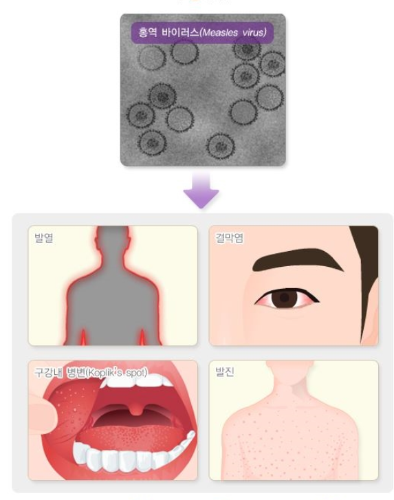 홍역이란