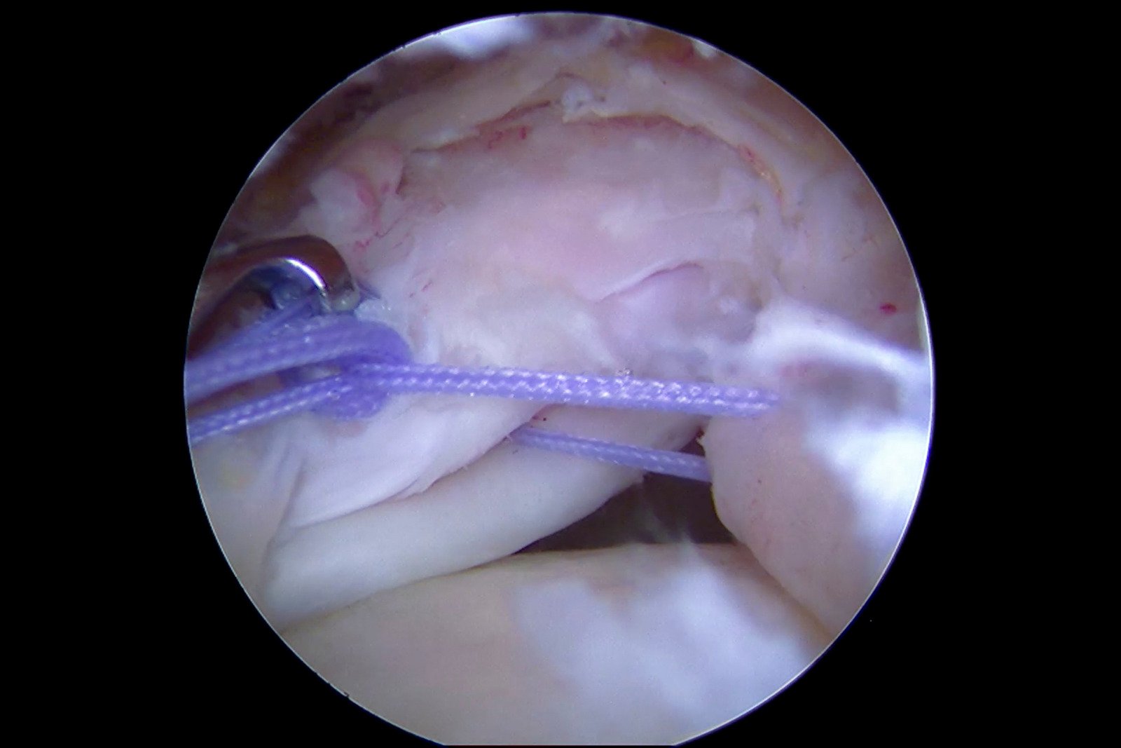 관절경 회전근개 봉합술 (Arthroscopic Rotator Cuff Repair) ❘ 수술 과정과 회복 가이드