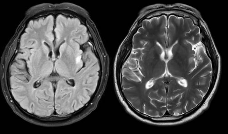 알츠하이머병과 관련된 사진