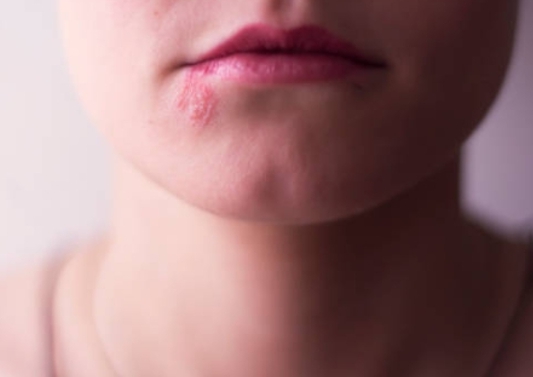 입가에 수포가 발생한 모습