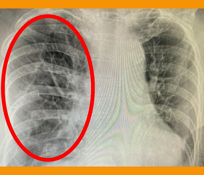 오른쪽 옆구리 통증 원인 - 갈비뼈 골절