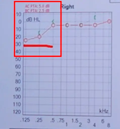 난청 검사_저주파 난청