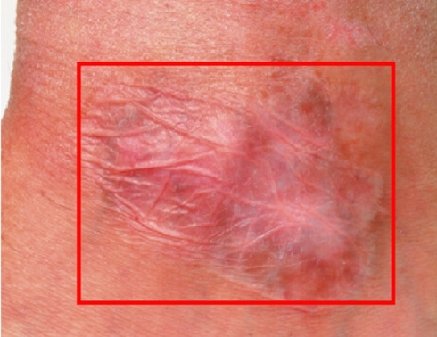 비후성 반흔 형태의 흉터