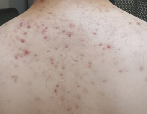 지성 피부 타입