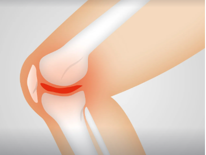 퇴행성 관절염 원인, 증상, 치료법 총 정리 (2025 ver.)