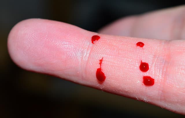혈우병(Hemophilia) &ndash; 원인, 증상, 최신 치료 동향