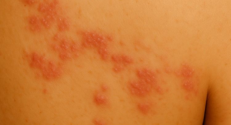 등 부위 피부에 경미하게 붉고 작은 수포가 부분적으로 분포된 초기 대상포진 상태를 표현한 의료 일러스트