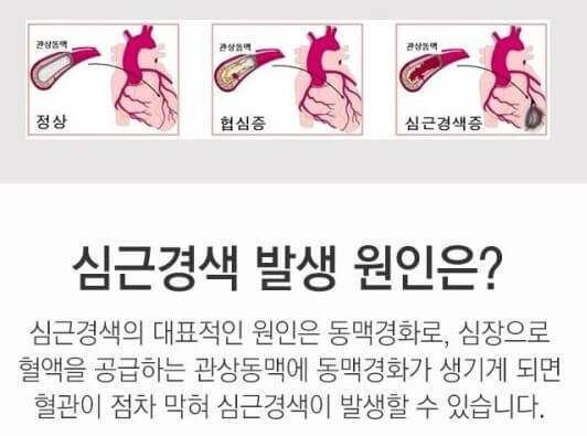 심근경색 원인