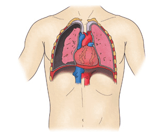 폐기흉 원인 증상 치료법