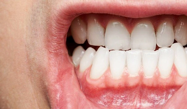 치은염 치료방법 영양제 추천