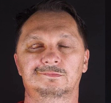 안면마비 전조증상 6가지