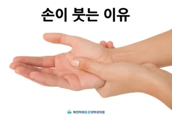 손등 붓는 이유 혈액순환 문제 증상과 해결법 정리_16