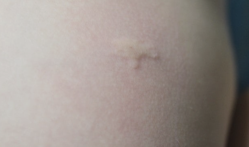 집먼지 진드기 물린자국