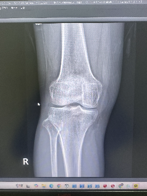 병원 모니터에서 확인되는 무릎(슬관절) 엑스레이 정면(AP) 영상
