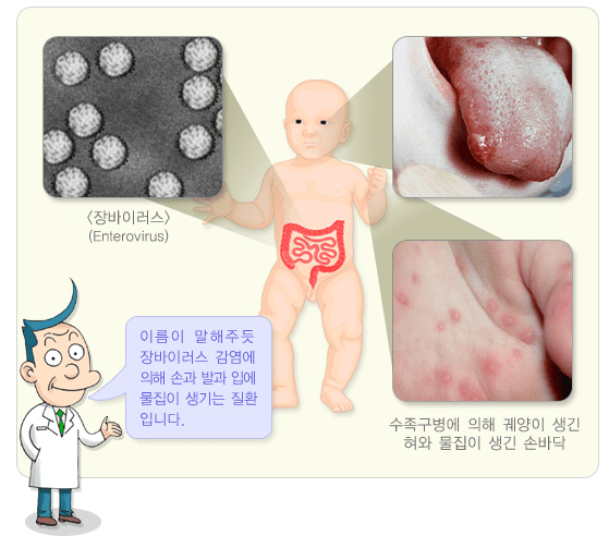 수족구 증상 및 바이러스
