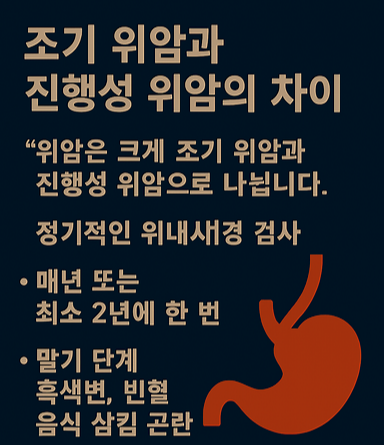 조기 위암과 진행성 위암의 차이