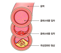 고지혈증 증상