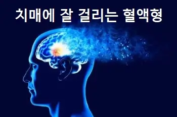 치매에 잘 걸리는 혈액형