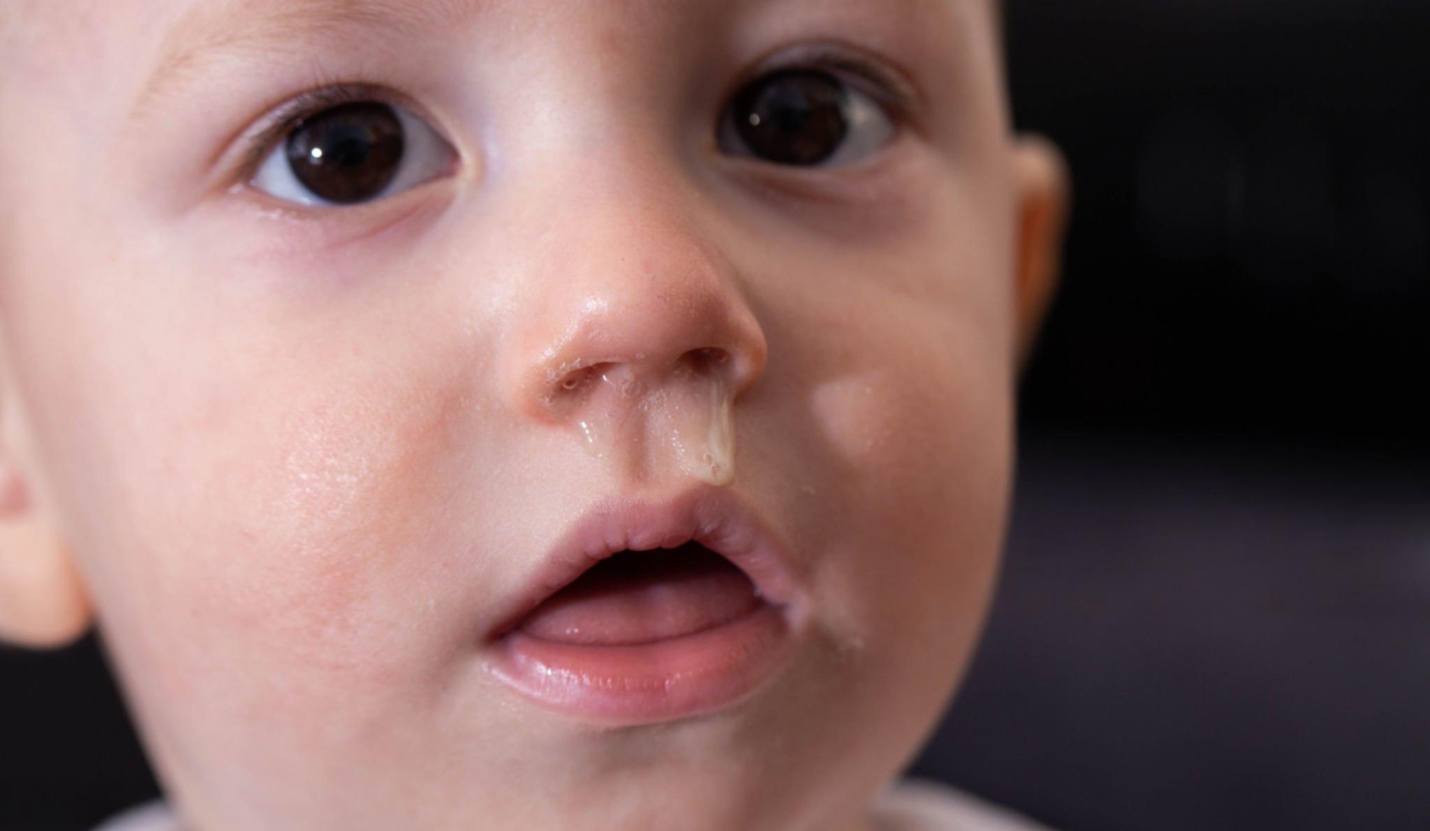 아이 콧물 감기