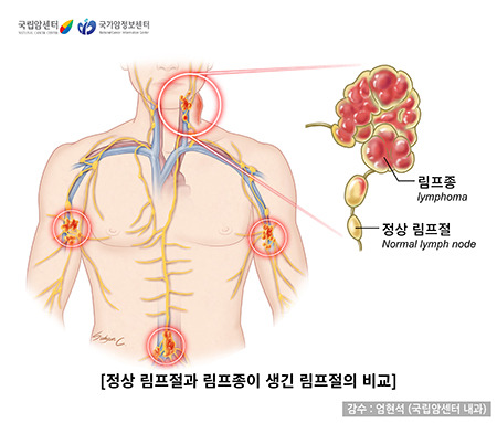 악성림프종 증상·원인·최신 치료법