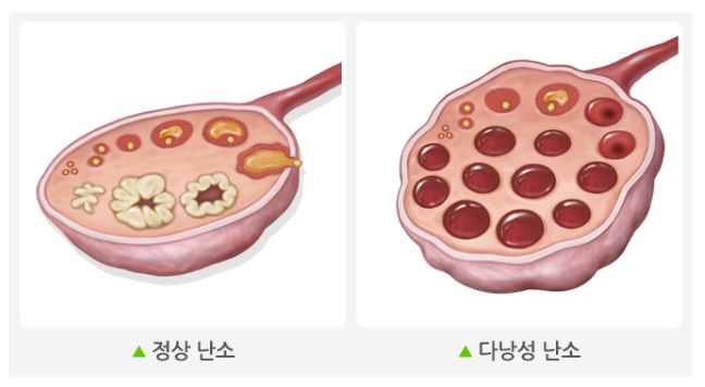 정상 난소와 다낭성 난소 비교 이미지