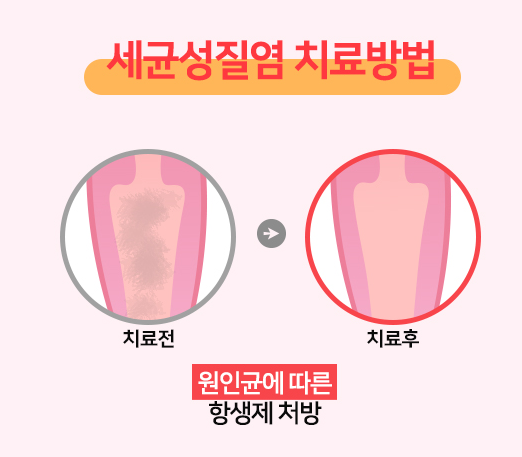 생리중 세균성질염