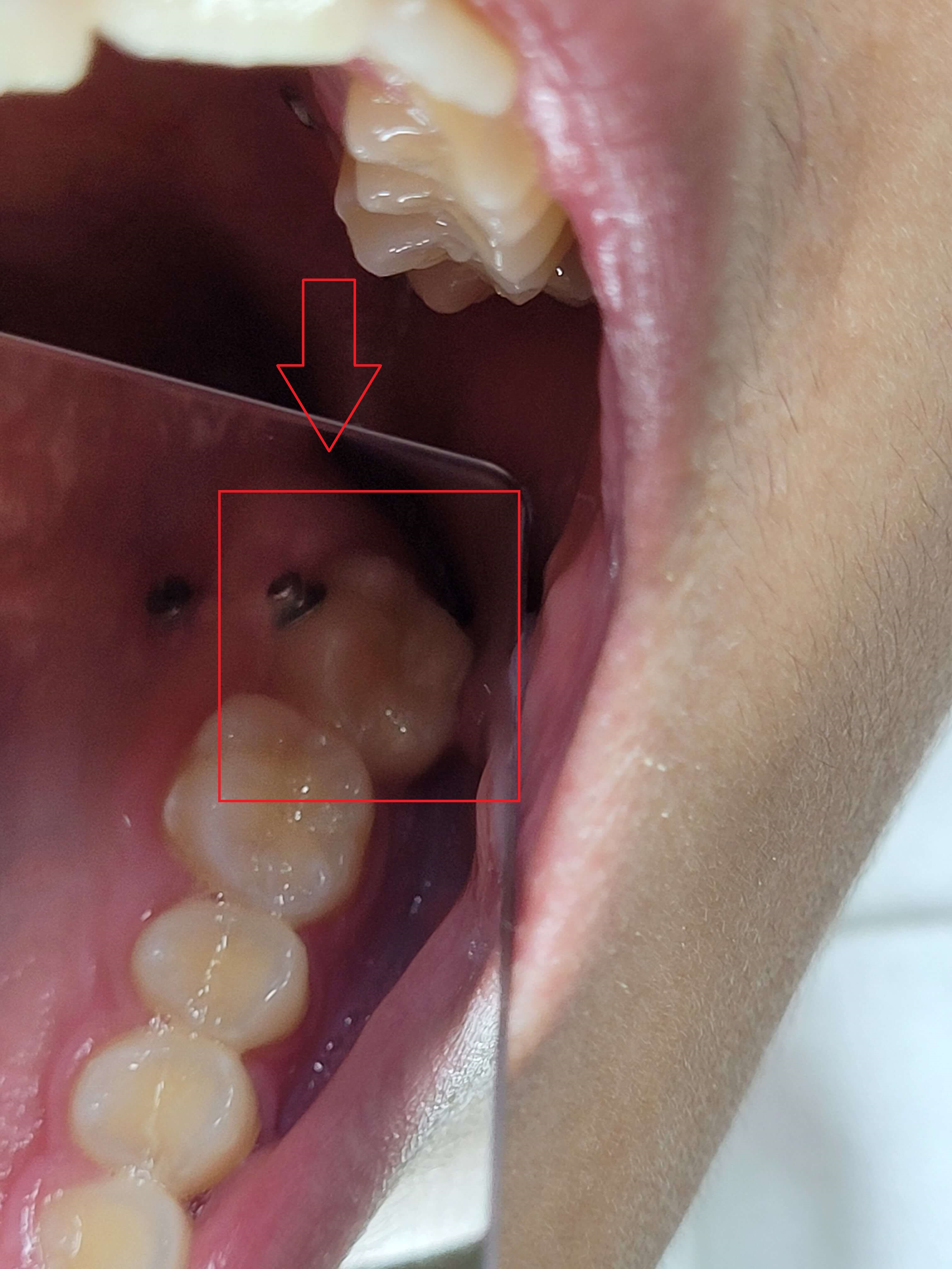 부정교합 가위교합 과개교합 치아교정 후기14