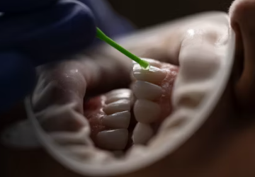 임플란트 시술과정 시술기간 시술 종류